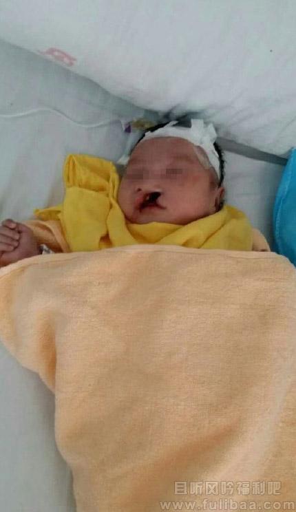 兔唇男婴被弃荒野