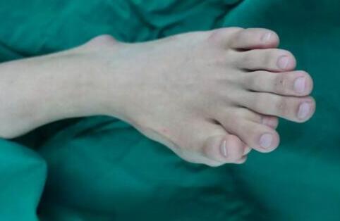 一足生9趾是怎么回事?潮汕小伙左脚生9趾买鞋都需大两码 - 壹忧舍