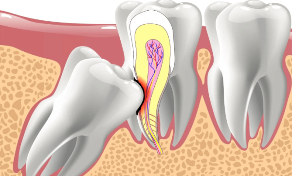 智齿有什么危害,为什么要拔掉? - 壹忧舍