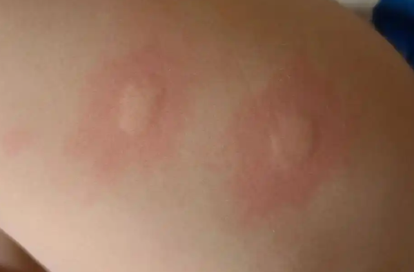 被蚊子咬后痒痛的背后,竟藏着这些秘密 - 壹忧舍