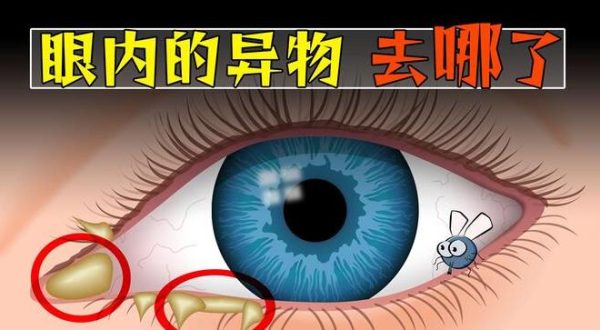 飞进眼睛的异物,消失去哪了? - 壹忧舍